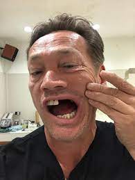 Stand in sid (6 episodes, 2020) Sid Owen Seen For The First Time Since Horror Golf Accident In Thailand Left Him With A Fractured Jaw