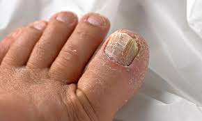 toenail fungus so difficult to treat