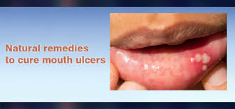 natural remes to cure mouth ulcers