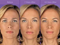 Maybe you would like to learn more about one of these? Botox Dysport Vancouver Laser Skin Care Clinic
