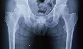 生澤 義輔 先生  島田 勇人 先生 | 筋肉を切らず、術後に脱臼を起こしにくい手術方法とは | 股関節の痛みは早期受診・治療で健康寿命の延伸を目指しましょう！  | 人工関節ドットコム