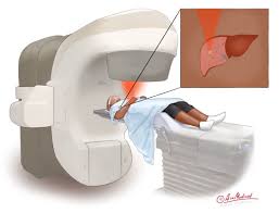 proton therapy for liver cancer treatment