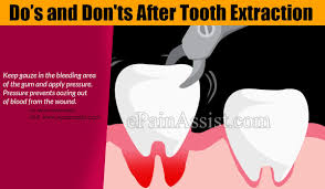 Many people find that the tooth extraction healing process is much more dreadful than the actual tooth pulling itself. Do S And Don Ts After Tooth Extraction