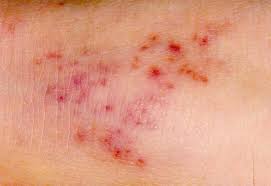 Blisters start on face before spreading to other areas. Meningitis Rash Pictures Symptoms And Similar Rashes