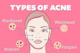 9 best overnight home remes for acne