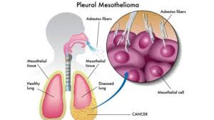 A collection of fluid around the lung, termed a pleural effusion, may be present. Pleural Mesothelioma Treatments And Symptoms Mesothelioma Feed