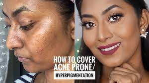 how to cover acne e skin