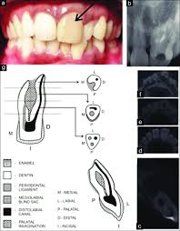 preoperative presentation of tooth 21
