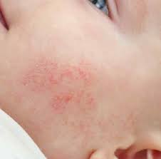 is baby acne a real thing know all