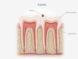 Als zahn ziehen bezeichnet man das entfernen eines zahnes (zahnextraktion, exodontie) ohne weitergehende operative maßnahmen. Loch Im Zahn Erkennen Ursachen Behandlung Zahnimplantate Com