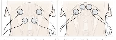 Figure 1 From Changes In Hyolaryngeal Movement And