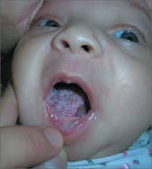 white coating on infant s tongue