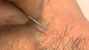They can appear on the scalp in those. How To Remove An Ingrown Hair Youtube