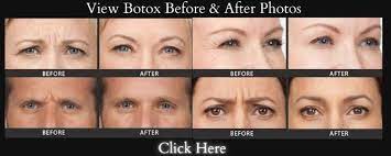 botox aftercare and post botox