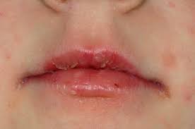 nhs 111 wales health a z dry lips