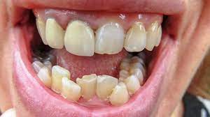 To fix crooked teeth, you might have to wear braces. Crooked Teeth Causes Concerns And How To Straighten