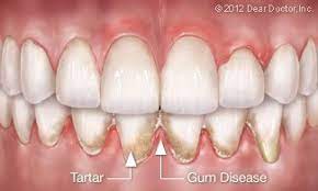 periodontal flap surgery inspire