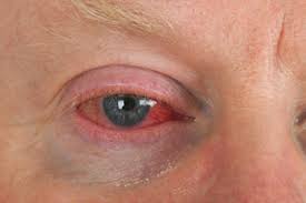 corneal abrasion injury lawsuits eye