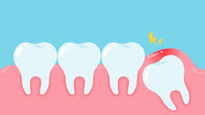 wisdom teeth symptoms complications