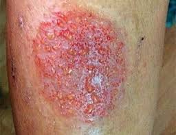 foot eczema causes symptoms
