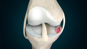 what is a meniscus tear how can i