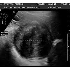 Cervical Fibroid Size At 36 Weeks 12 9 X 9 47 Cm Download