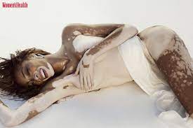 Winnie Harlow Poses Nude to Show Beauty of Her Vitiligo