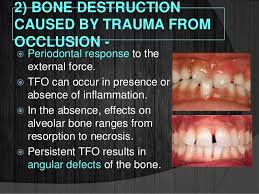 When needed, we can grafting bone can add years of life to a compromised tooth or even completely reverse the damage. Bone Loss And Patterns Of Bone Destruction
