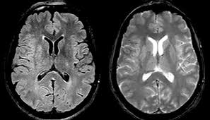 130.000 an multiple sklerose (ms) erkrankte. Bildgebung Bei Ms Schlaganfall Gehirntumor Philips Healthcare