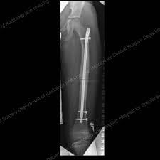 femur fracture broken thighbone in