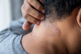 psoriasis on face symptoms causes and