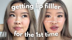 first time getting lip filler 4