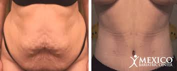 tighten excess skin after bariatric surgery