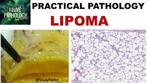 lipoma gross microscopy types and