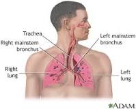 Image result for icd code 10 for aspiration pneumonia