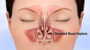 If your nasal septum is deviated, surgery provides the most lasting and effective solution. Deviated Nasal Septum Treatment Philadelphia Septoplasty Septorhinoplasty
