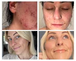 before and after acne with jessica holt