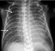 This condition is also called hyaline membrane what causes rds? A Chest Radiograph Of A Premature Infant With Respiratory Distress Download Scientific Diagram