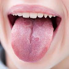 red patches on the tongue