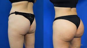 The price of a bbl procedure ranges greatly depending on the amount of donor sites you will be using for liposuction. Brazilian Butt Lift For Fort Worth Abilene Tx Dr Steven Camp