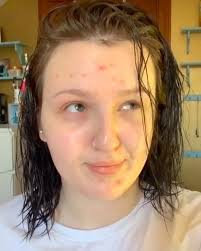 this tiktok acne concealing makeup hack
