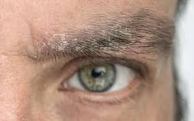 eyelid dermais symptoms causes