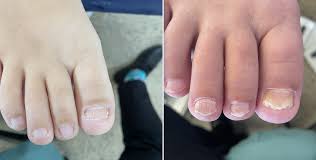 toenail fungal infection ace health