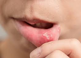 how to check for mouth cancer at home