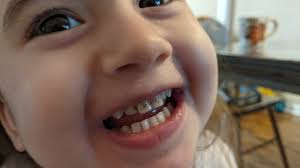 tooth decay in children 3 simple