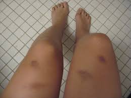 Skin Contusion Dating Dating Of Bruises In Abuse Child