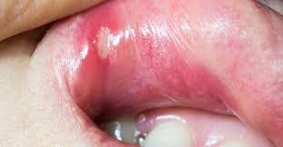 mouth ulcer home remes 15 effective