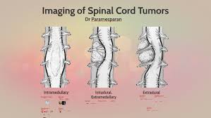 spinal cord tumors radiology by kethes