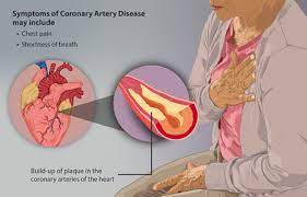 coronary artery disease cad physiopedia