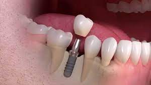 single tooth implants altima dental